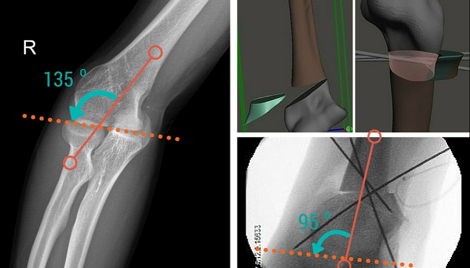 Elbow Deformity