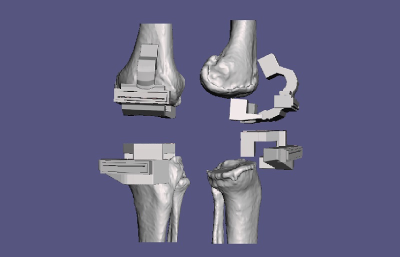 3D kişiye özel diz protezi ameliyatı